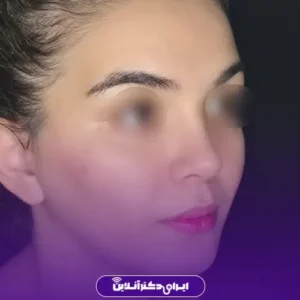 نمونه کار عمل بینی دکتر کتایون انصاری 1
