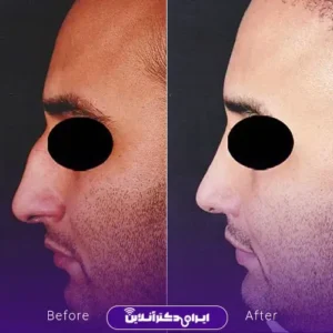نمونه کار عمل بینی دکتر کتایون انصاری 10