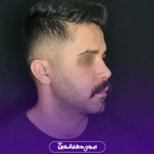 نمونه کار عمل بینی دکتر کتایون انصاری 2