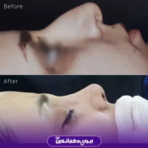 نمونه کار عمل بینی دکتر کتایون انصاری 5