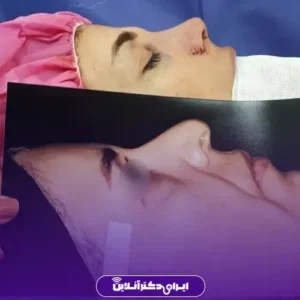 نمونه کار عمل بینی دکتر کتایون انصاری 6