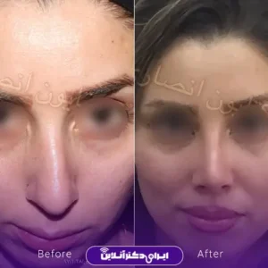 نمونه کار عمل بینی دکتر کتایون انصاری 7
