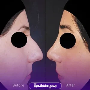 نمونه کار عمل بینی دکتر کتایون انصاری 8
