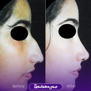 نمونه کار عمل بینی دکتر کتایون انصاری 9