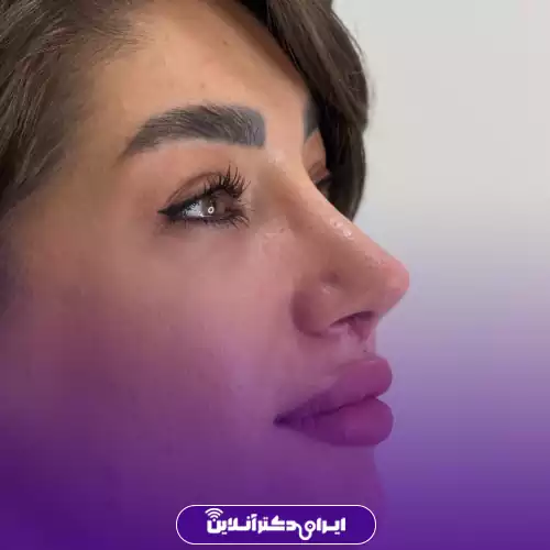 نمونه کار عمل بینی دکتر سیده وحیده موسوی بایگی 2