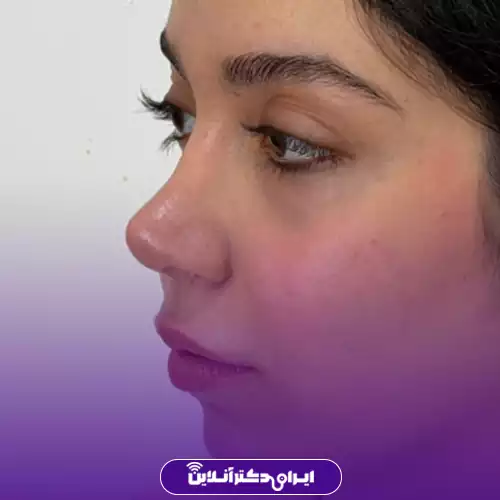 نمونه کار عمل بینی دکتر سیده وحیده موسوی بایگی 4