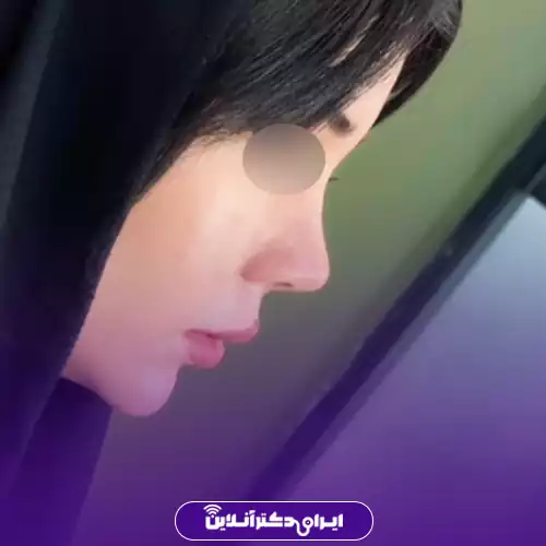 انواع عمل بینی 42 مدل بینی سرسرهای