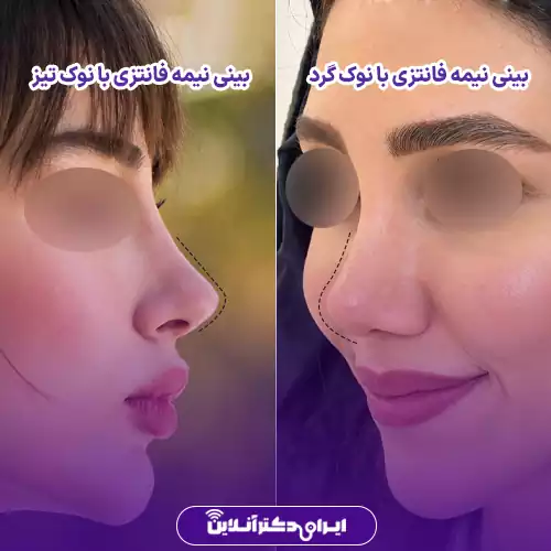 بینی نیمه فانتزی نوک گرد چه شکلی است و به چه چهرهای میآید؟ 5 تفاوت بینی نیمه فانتزی نوک گرد با بینی طبیعی، عروسکی و نوک تیز 2