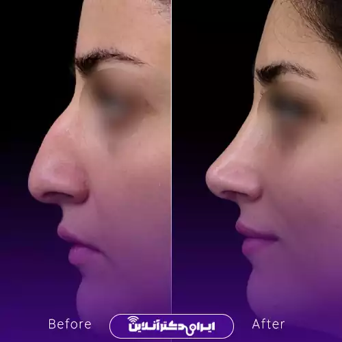 ترند بینی طبیعی یا نچرال 2