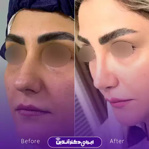 ترند بینی طبیعی یا نچرال 3