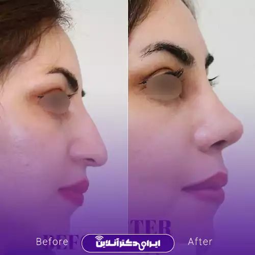 ترند بینی طبیعی یا نچرال 4
