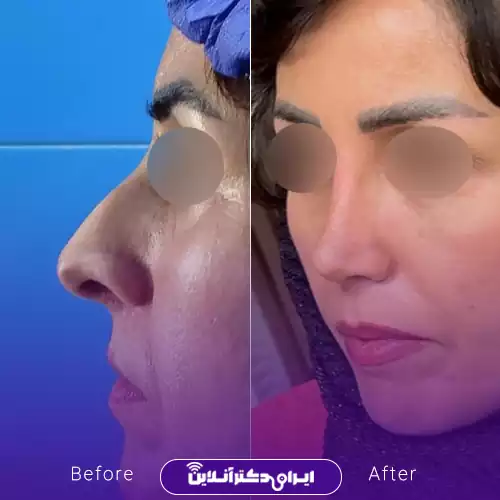 ترند بینی طبیعی یا نچرال 5
