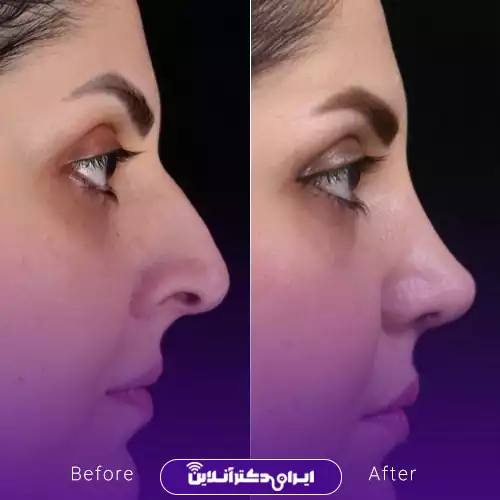 ترند بینی نیمه فانتزی با قوس ملایم 2