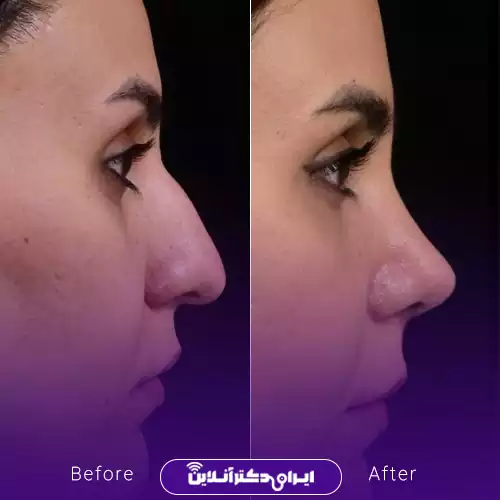 ترند بینی نیمه فانتزی با قوس ملایم 3