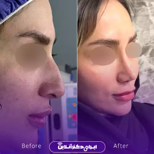 ترند بینی نیمه فانتزی با قوس ملایم 4