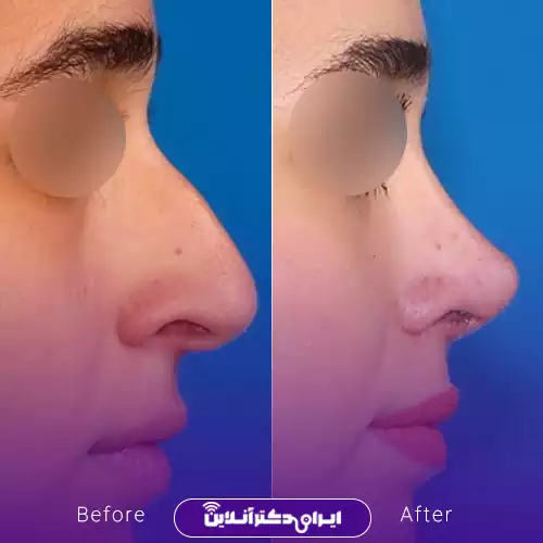 ترند بینی نیمه فانتزی با قوس ملایم 5
