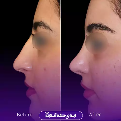 ترند بینی باریک با حفظ ویژگی‌های چهره (قلمی) 2