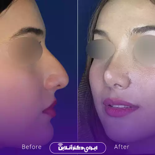 ترند بینی باریک با حفظ ویژگی‌های چهره (قلمی) 3
