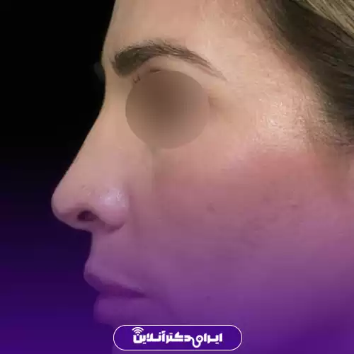 بینی قوزدار ترند 3