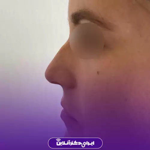 بینی قوزدار ترند 4