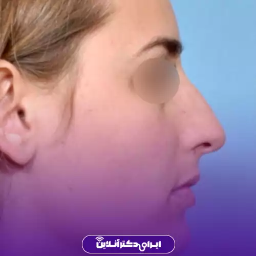 بینی قوزدار ترند 5