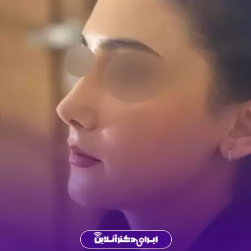 انواع عمل بینی 43 مدل بینی به سبک V